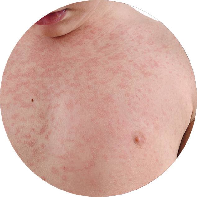 rash